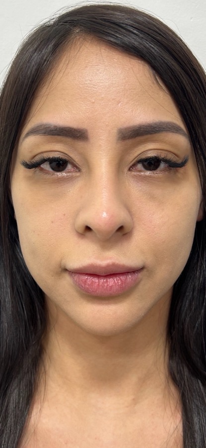Antes